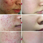 Herbal Acne Scar Removal Face Cream