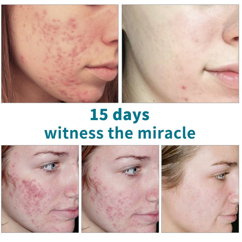 Salicylic Acid  For Acne Treatment, Anti-acne,  Shrink Pores, Moisturizing Serum Remove Blackheads Skin Care
