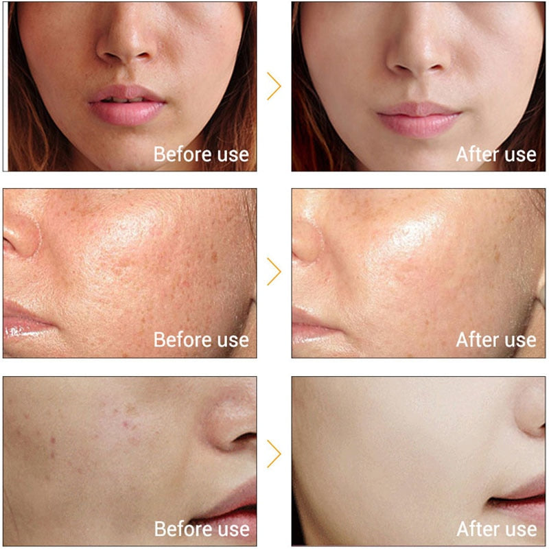 Vitamin C Whitening Dark Face Serum To Remove Dark Spots, Freckles