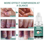 Nail Fungal Treatment Essence Oil