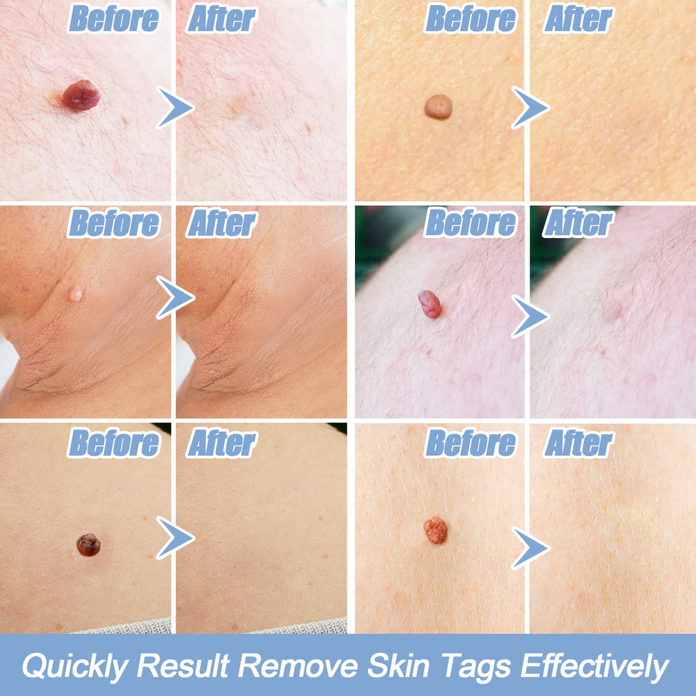 Painless Auto Skin Tag Remover