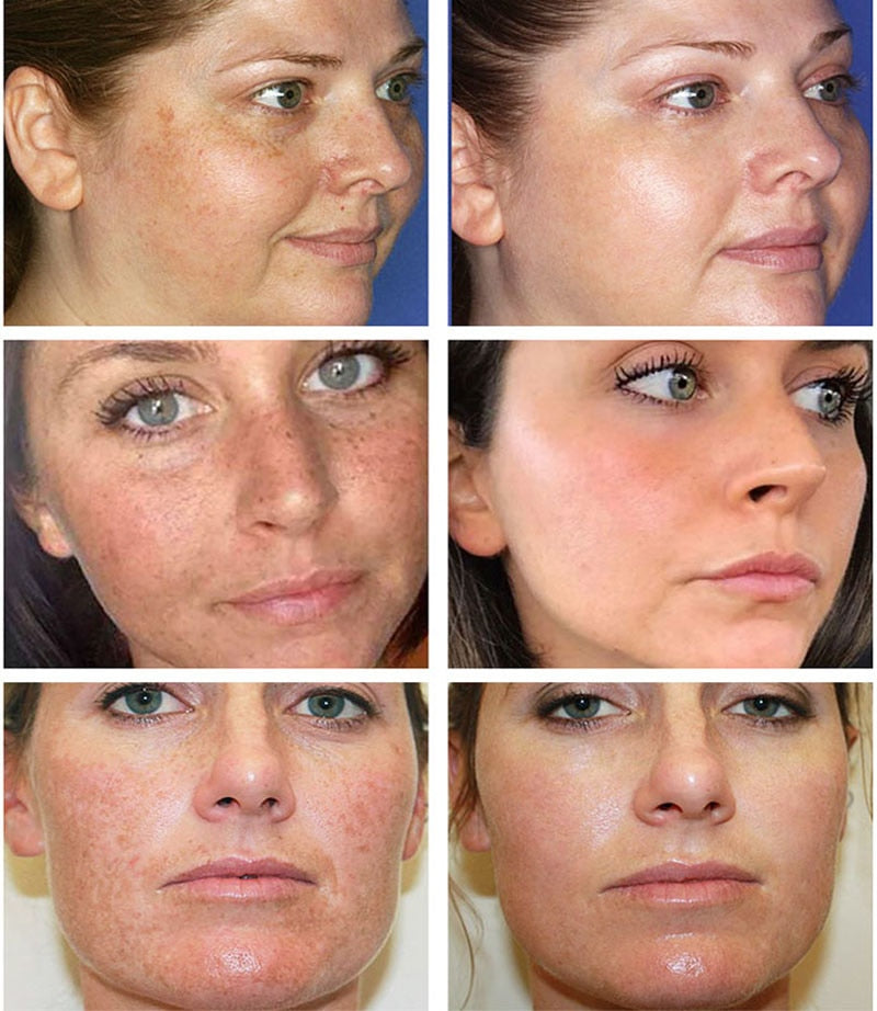 Vitamin C Whitening Dark Face Serum To Remove Dark Spots, Freckles