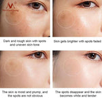 Freckle Remover Cream Removes Acne Spots Melanin Dark Spots Face Lift Firming Whitening