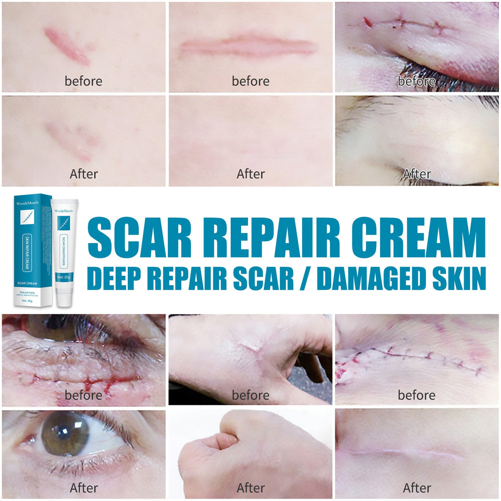 Herbal Scar Removal Cream