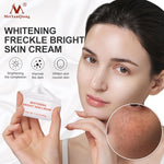 Freckle Remover Cream Removes Acne Spots Melanin Dark Spots Face Lift Firming Whitening
